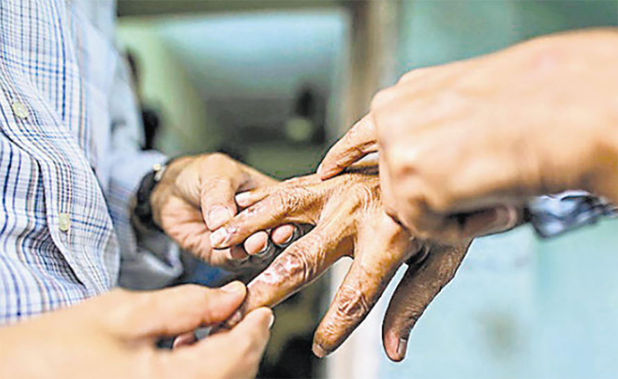 बाँके कुष्ठरोगको उच्च जोखिममा Image